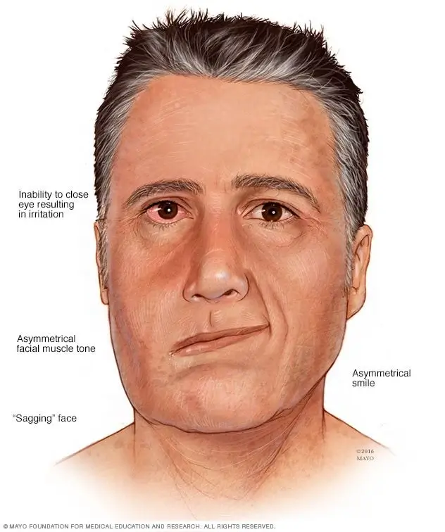 Facial nerve disorders